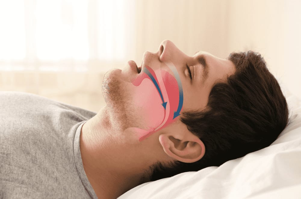 Snoring & Sleep Apnea Surgery