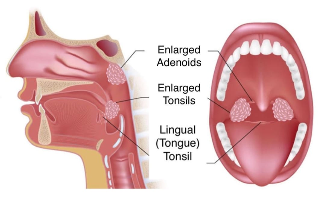 Tonsils & Adenoids Infection check